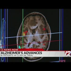 Alzheimer's drug shows promise in early results of study